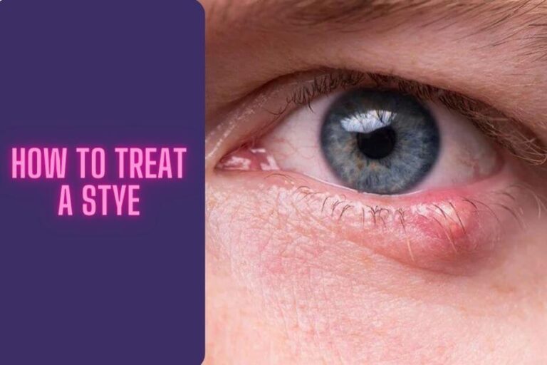 How to Treat a Stye? Home Remedies and Tips for Relief